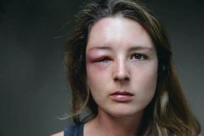 Prevent Painful Stings with Stinging Insects' Removal!