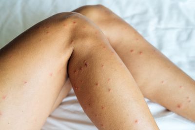 Bed Bugs Cause Bites!