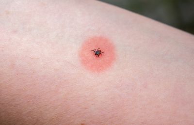 Prevent Issues in The Future by Getting Professional Tick Extermination